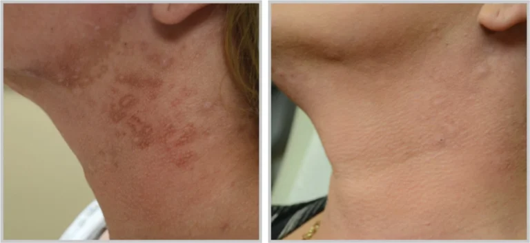 Before and After Halo Laser Treatment - Neck